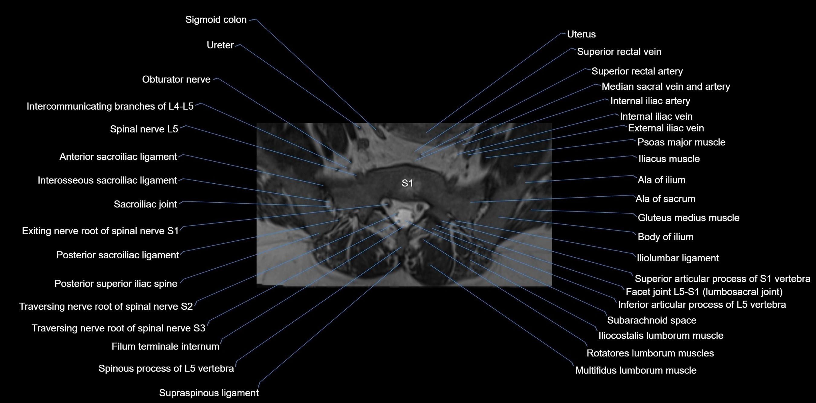 MRI sacrum, coccyx and sacroiliac joint axial cross sectional anatomy 3T  radiology  image-img-00001-00011.webp